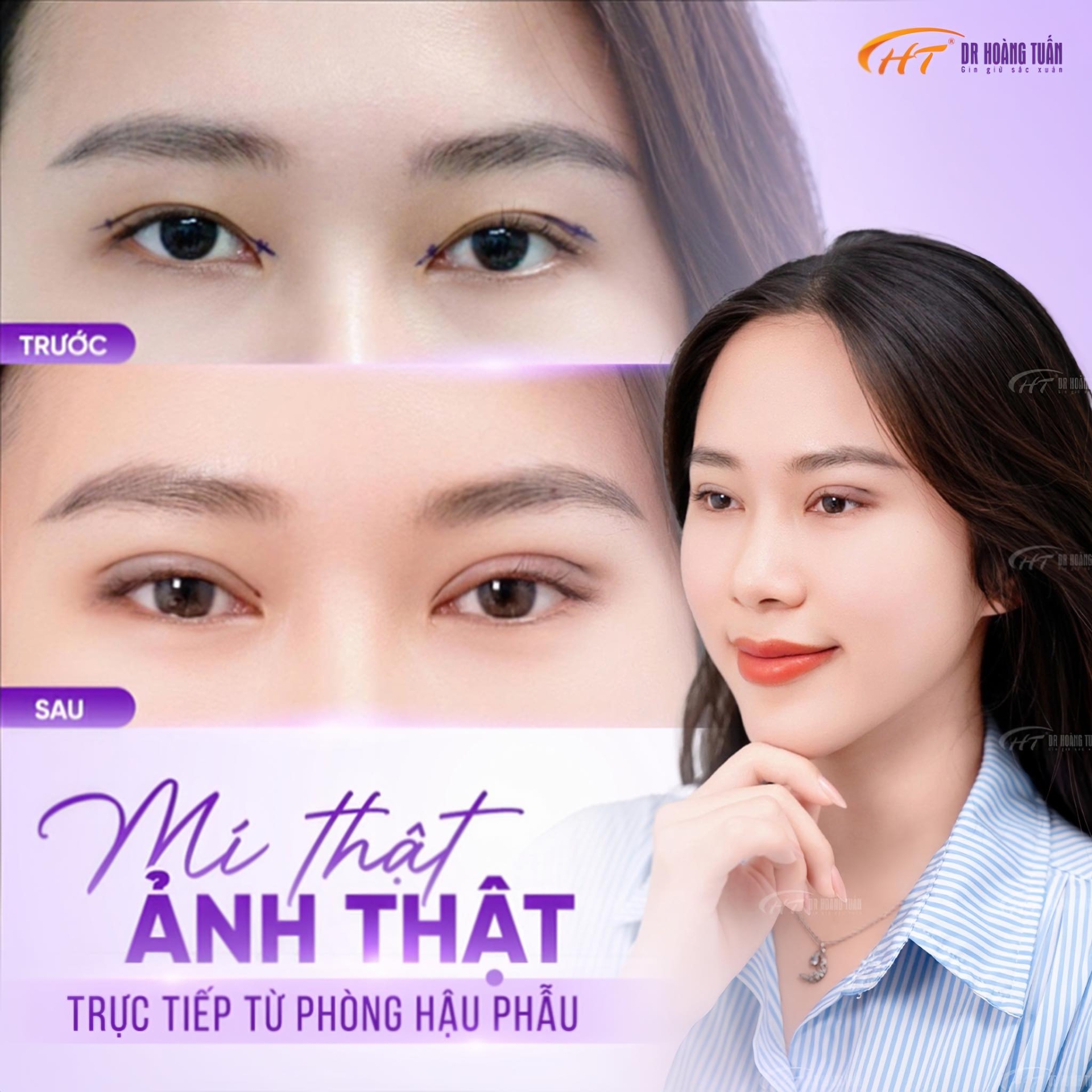 phẫu thuật thẩm mỹ mắt nhỏ