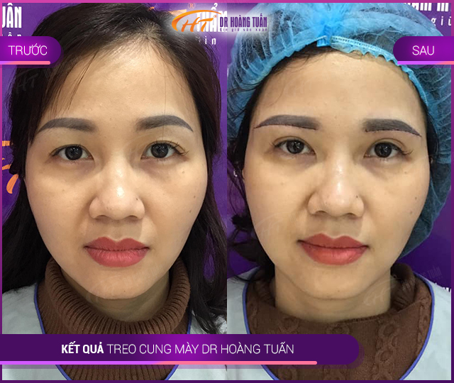 phẫu thuật thẩm mỹ mắt nhỏ