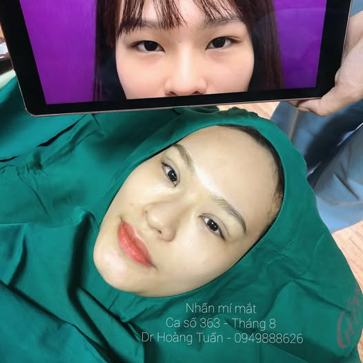 phẫu thuật thẩm mỹ mắt xếch