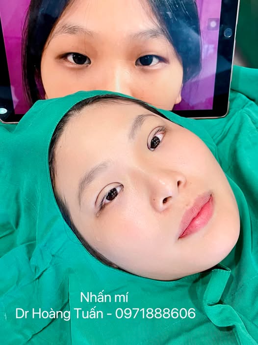 phẫu thuật thẩm mỹ mắt xếch