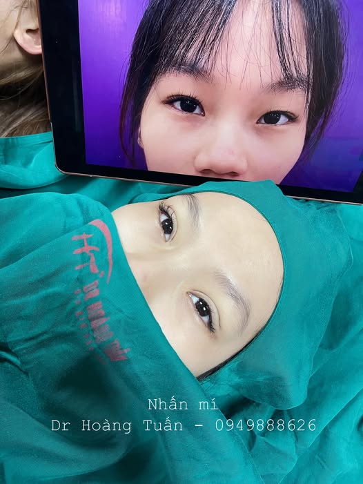 phẫu thuật thẩm mỹ mắt xếch