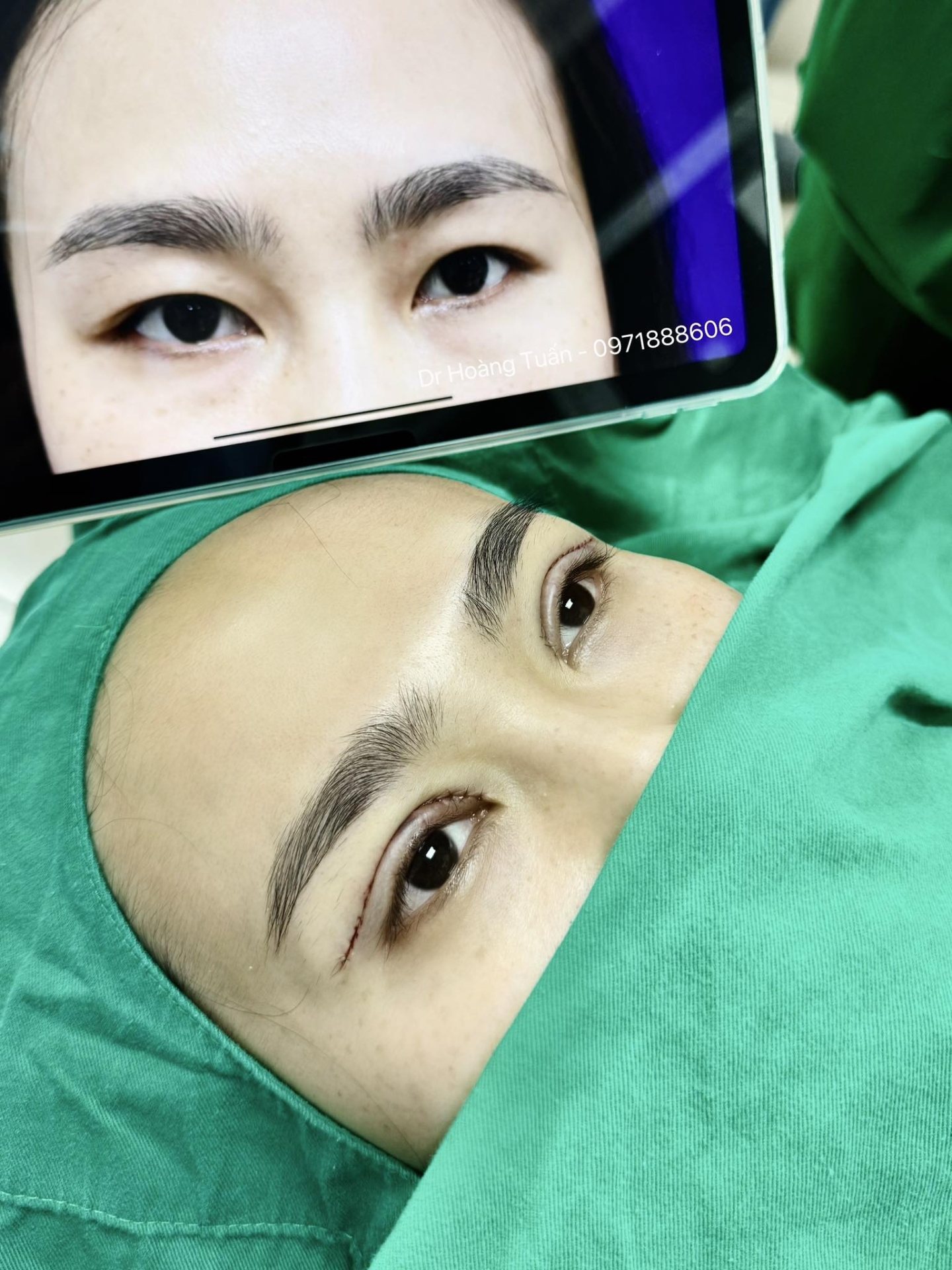 phẫu thuật thẩm mỹ mắt xếch