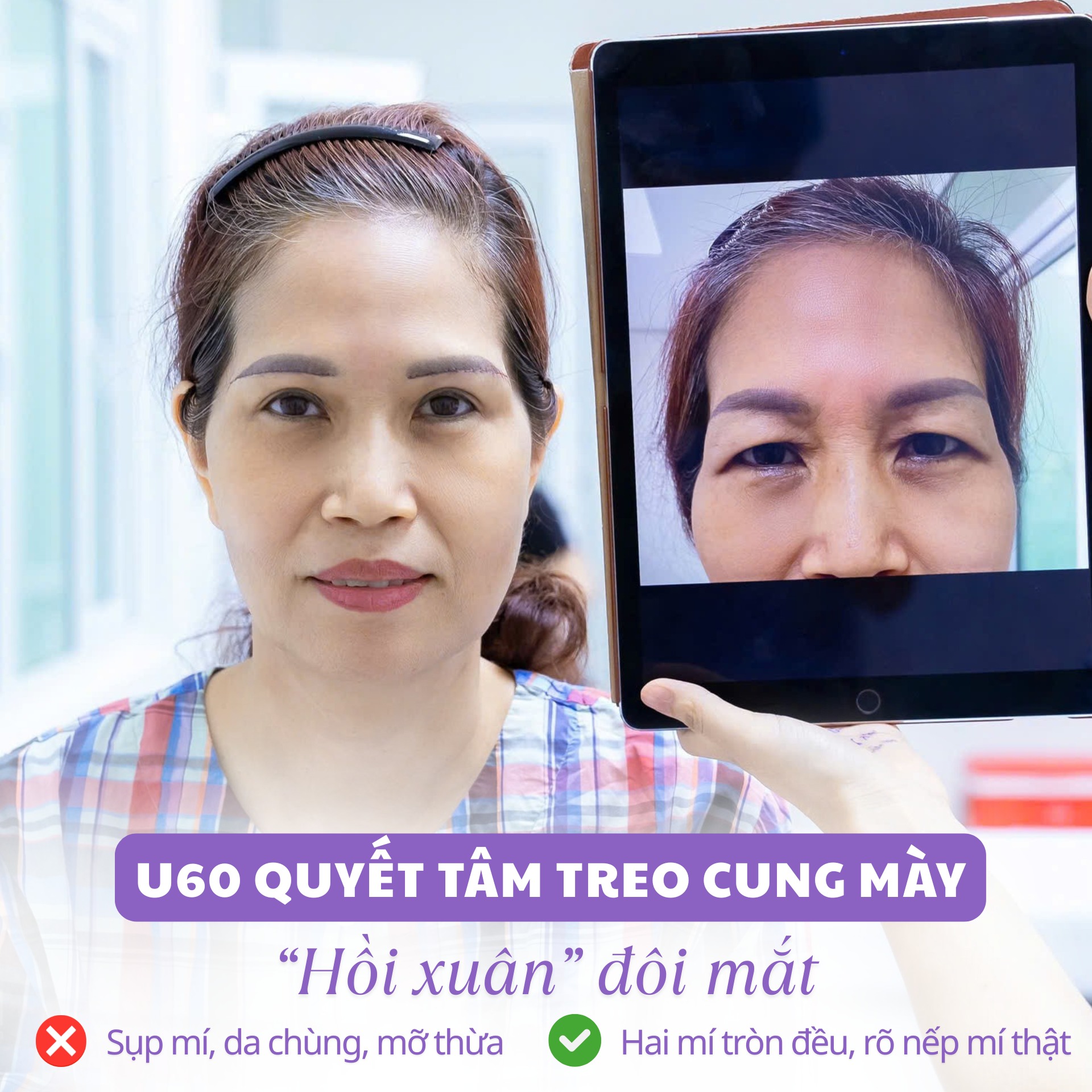 phẫu thuật thẩm mỹ mắt sụp mí