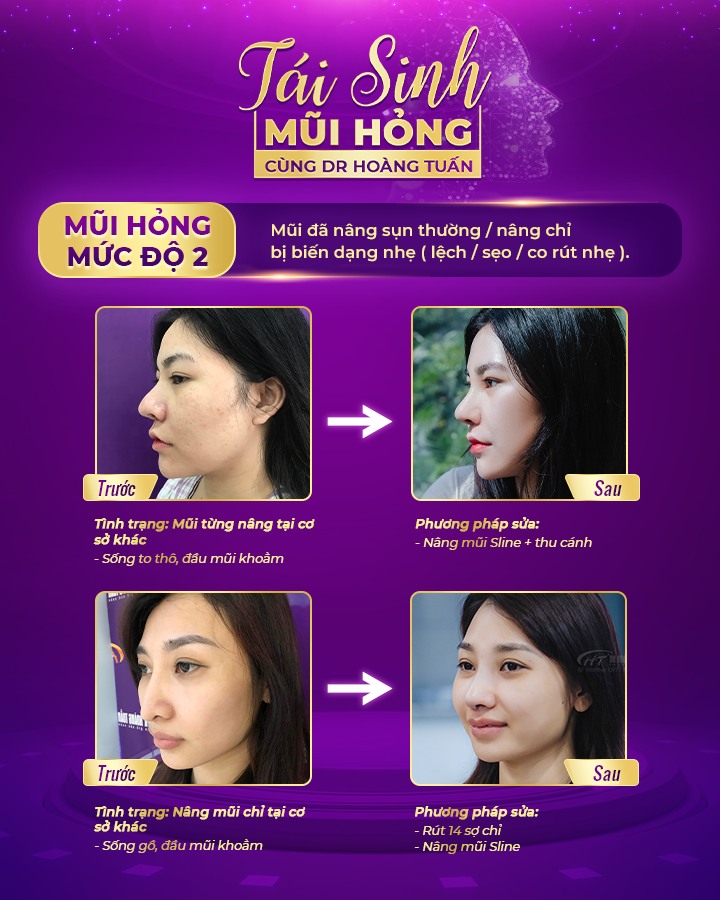 hậu quả của nâng mũi khi về già