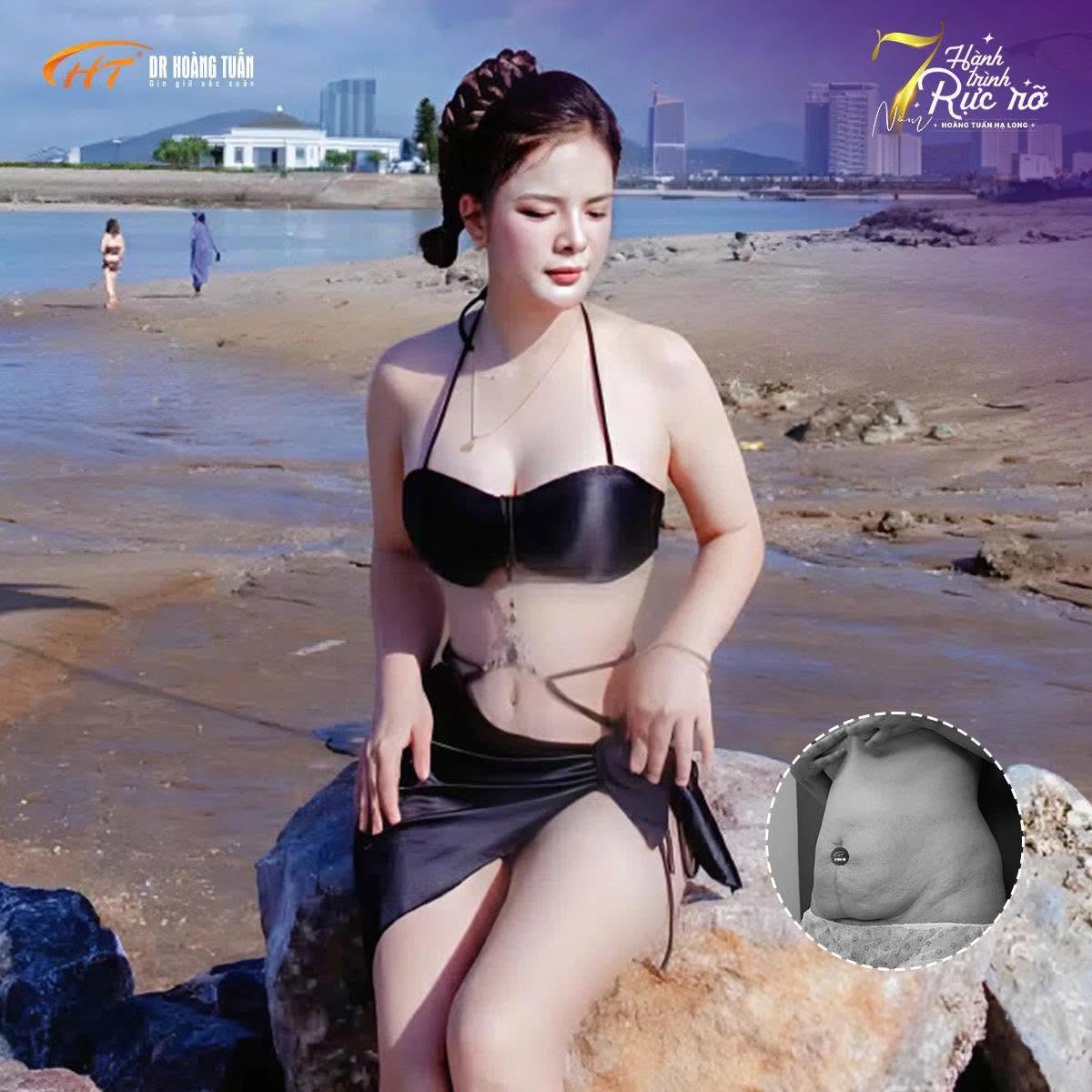 tạo h&igrave;nh bụng bao l&acirc;u th&igrave; hết đau