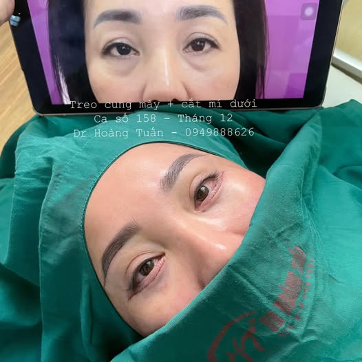 thẩm mỹ bọng mắt dưới