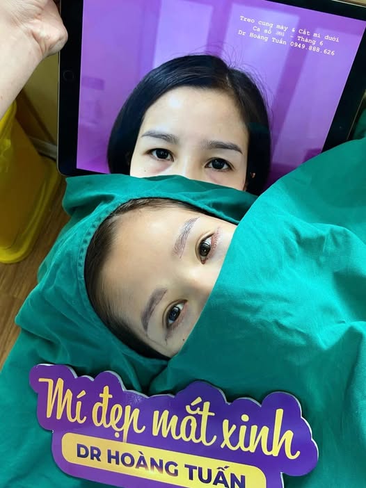 thẩm mỹ bọng mắt dưới