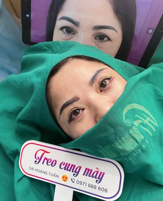 thẩm mỹ bọng mắt dưới