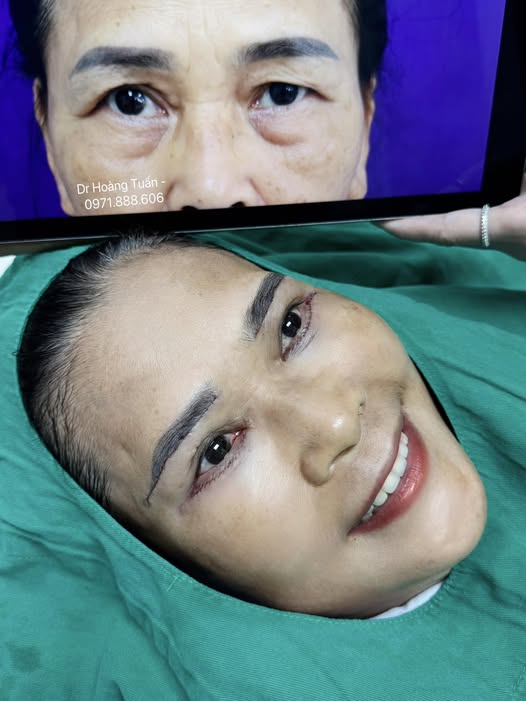 cắt da thừa mí mắt dưới