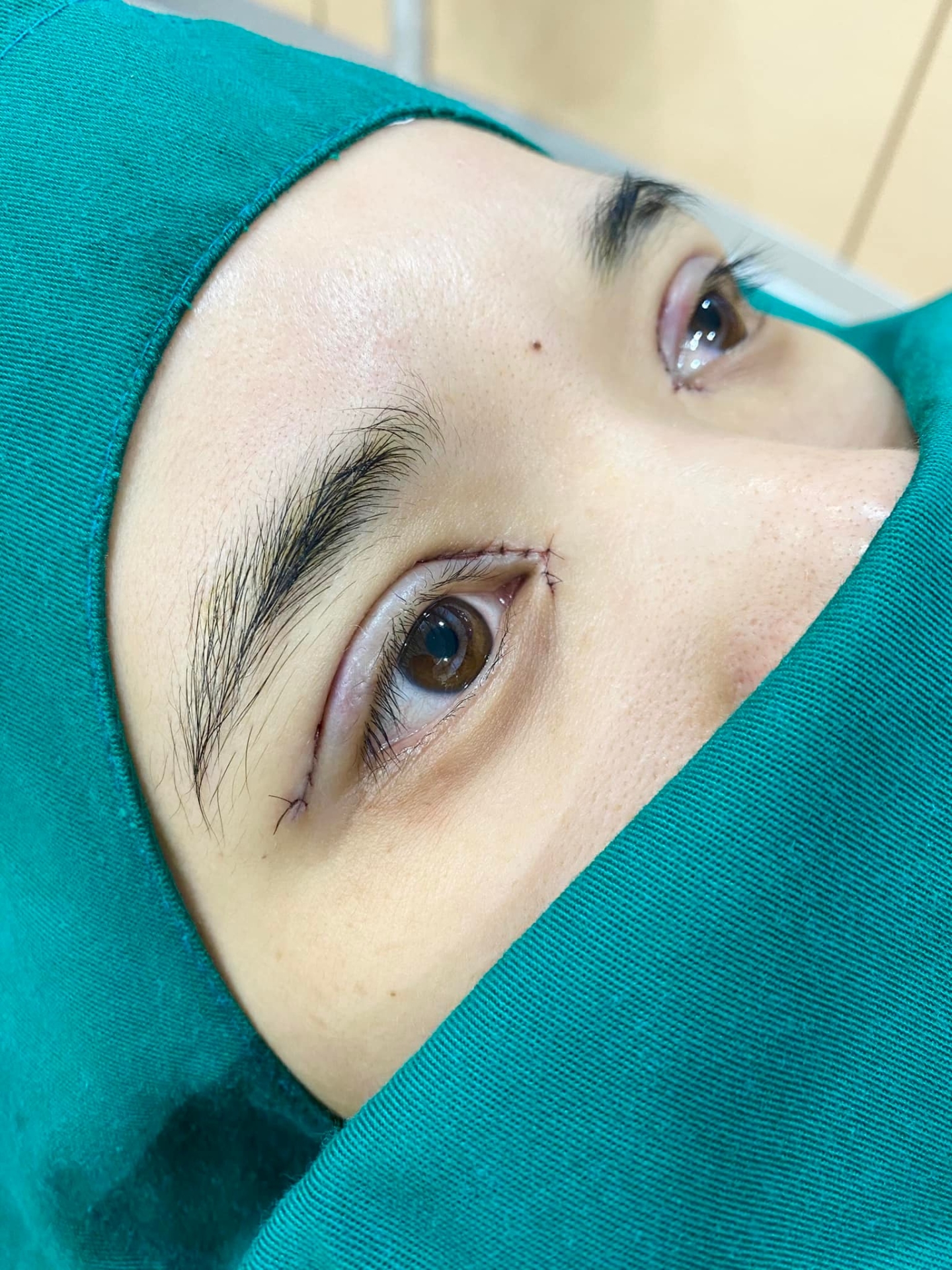 phẫu thuật thẩm mỹ mắt to