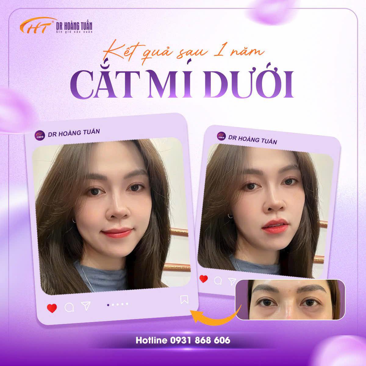 phẫu thuật thẩm mỹ mắt to