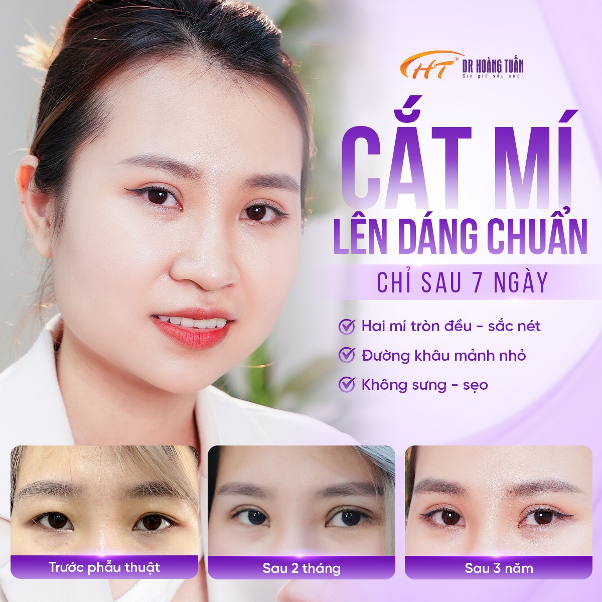 phẫu thuật thẩm mỹ mắt to