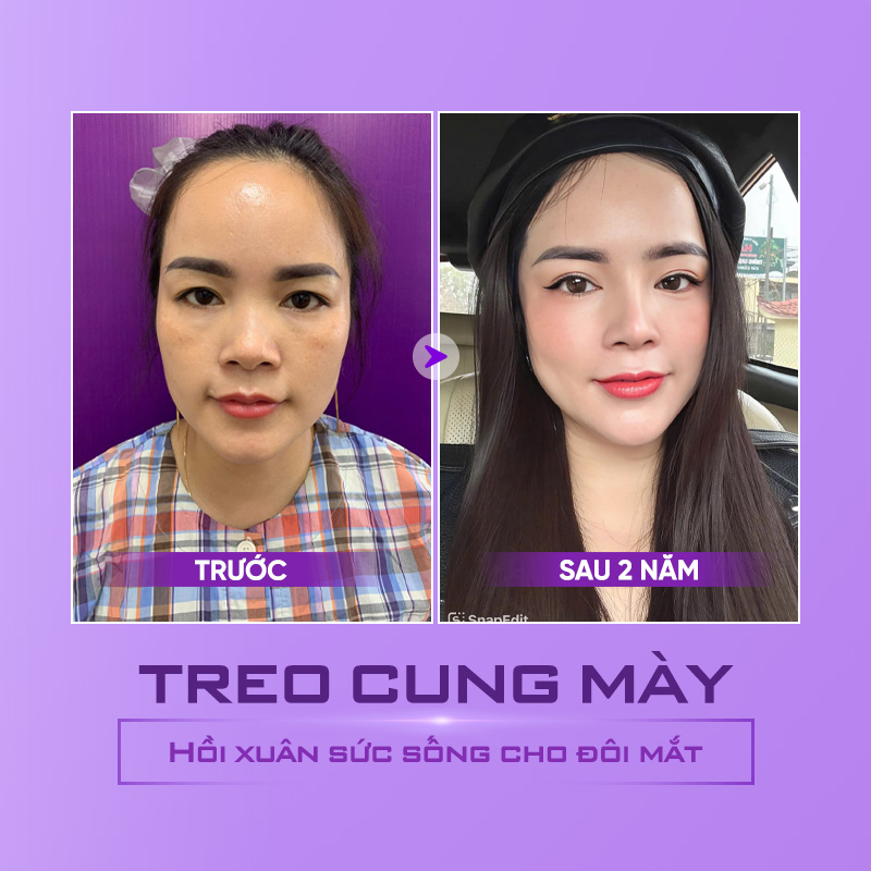 phẫu thuật thẩm mỹ mắt to