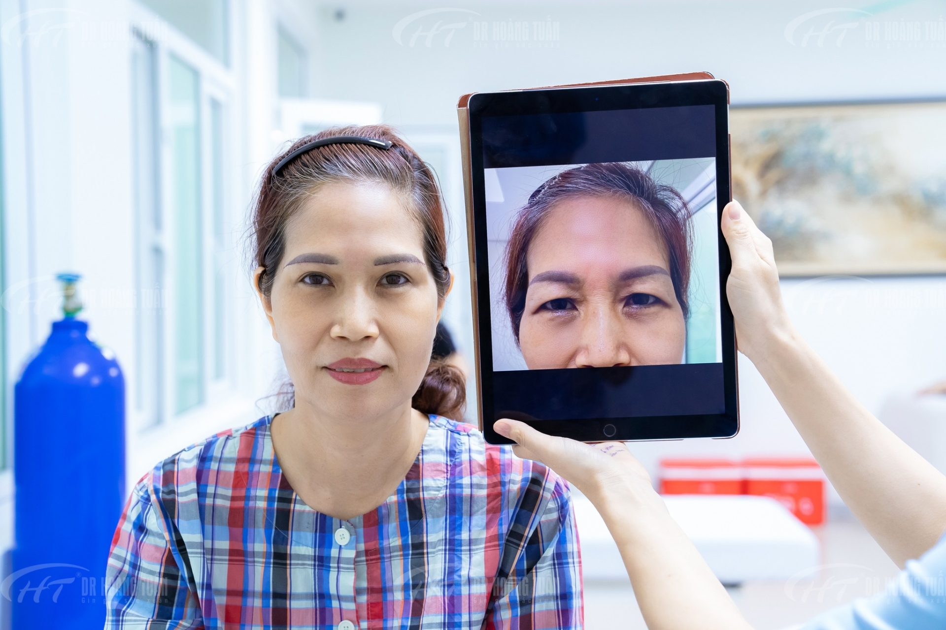 thẩm mỹ mí mắt chảy xệ