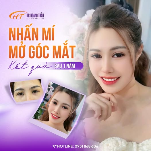 phẫu thuật thẩm mỹ mắt nhỏ