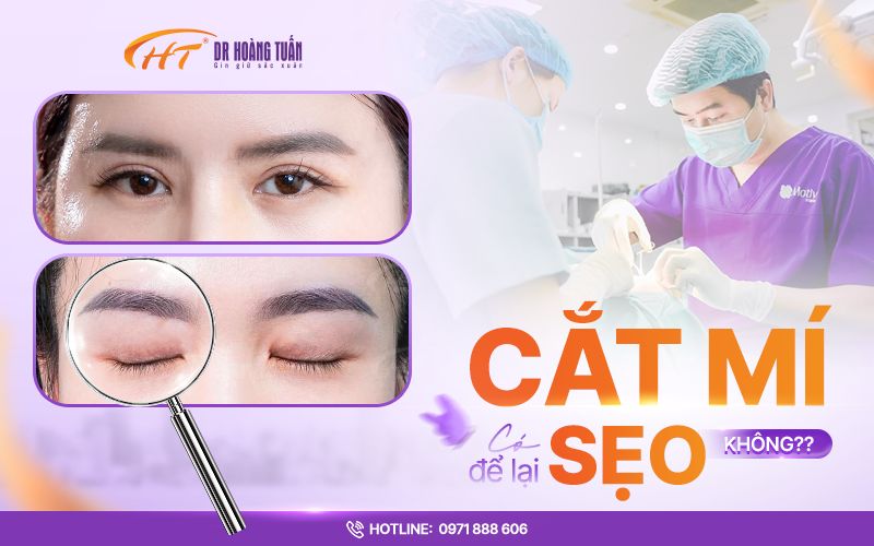 Cắt mí có để lại sẹo không? Sự thật bạn cần biết