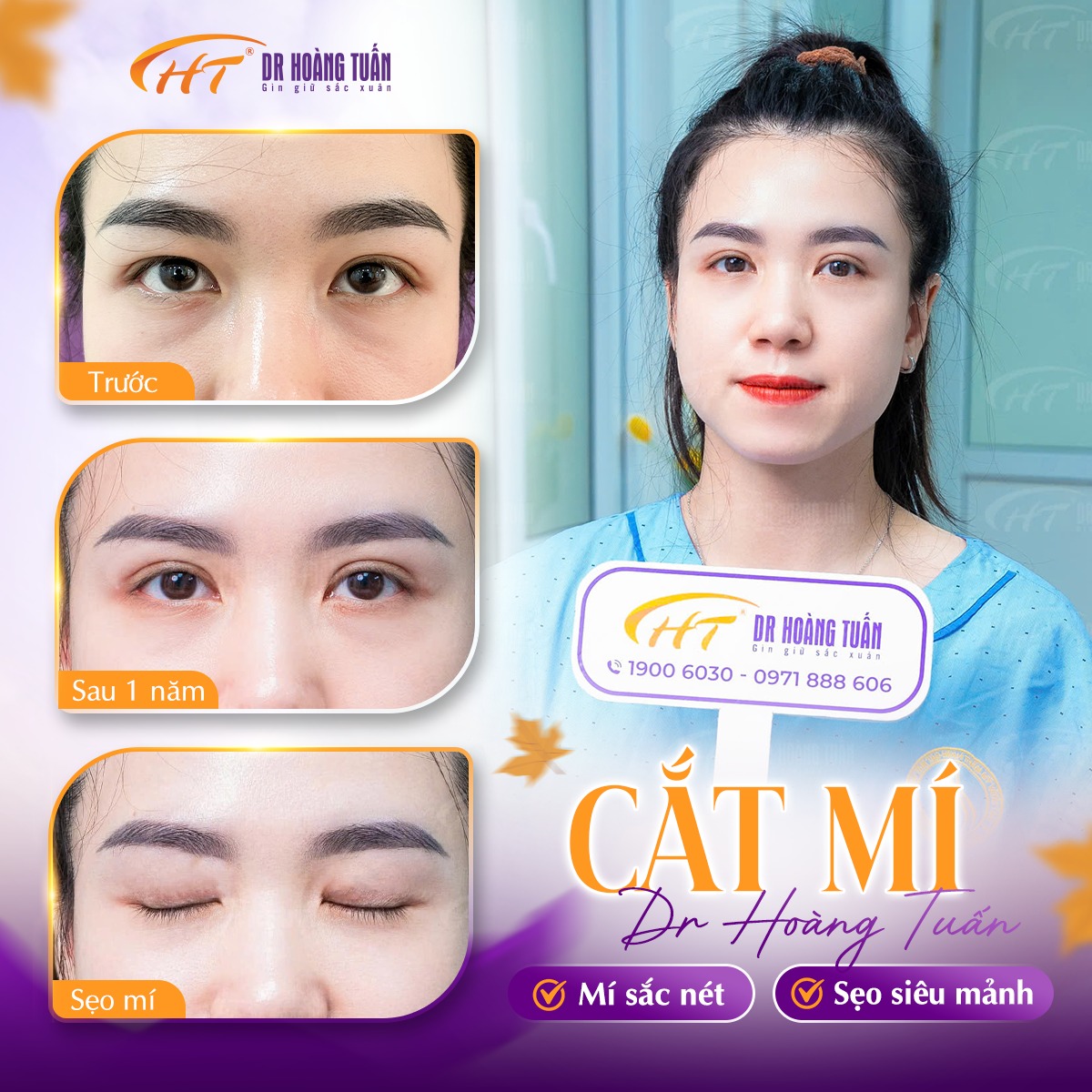 Kết quả cắt mí sau 1 năm tại Dr Hoàng Tuấn