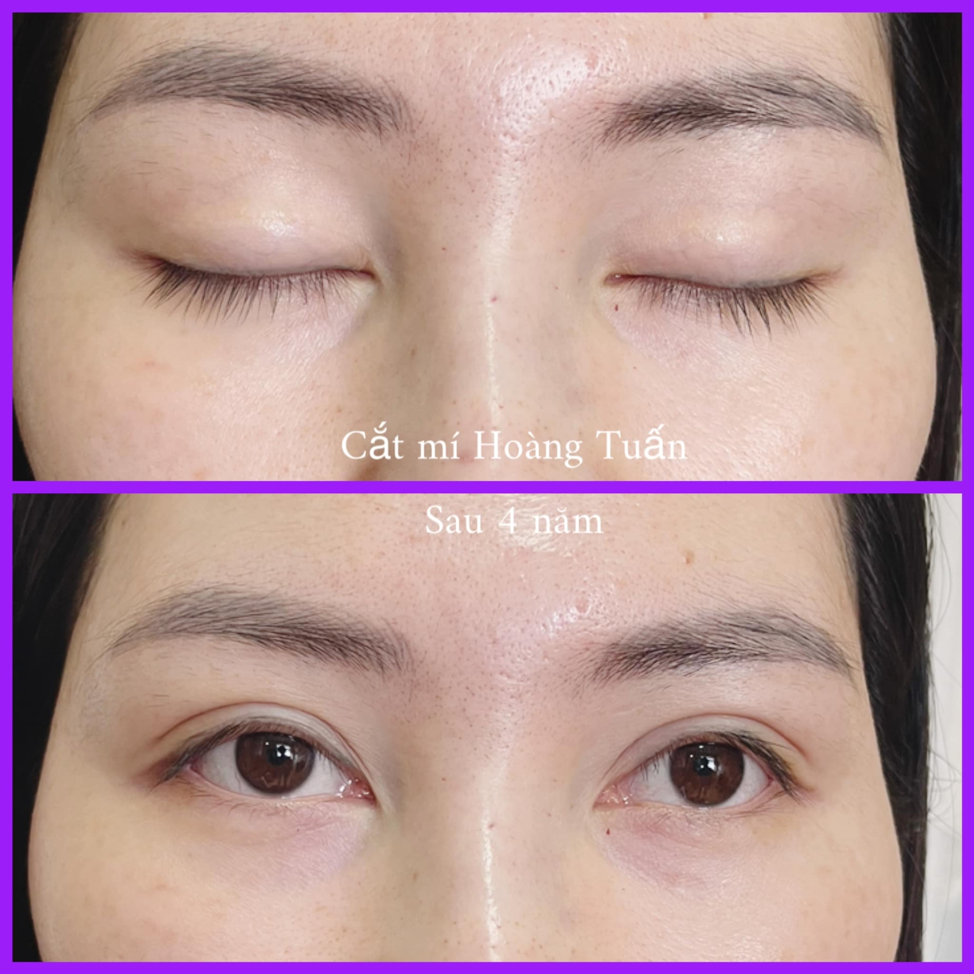 Kết quả cắt mí sau 4 năm tại Dr Hoàng Tuấn