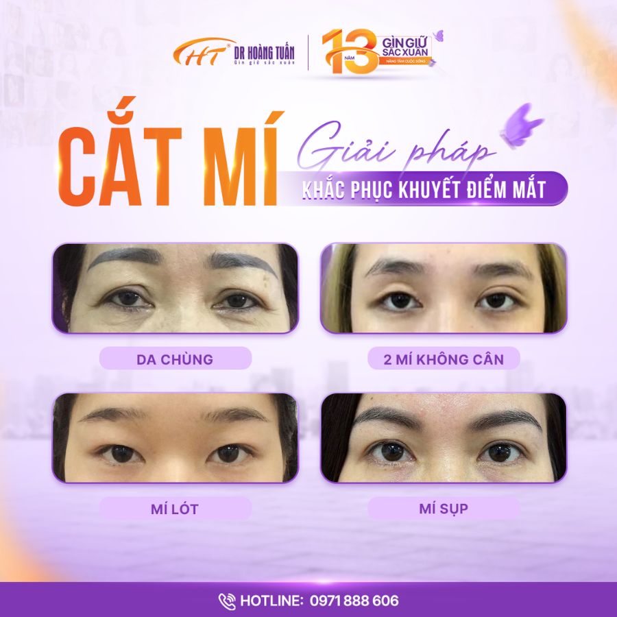 Đối tượng phù hợp cắt mí