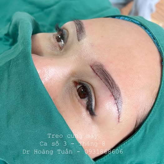 treo cung m&agrave;y bao l&acirc;u th&igrave; hồi phục