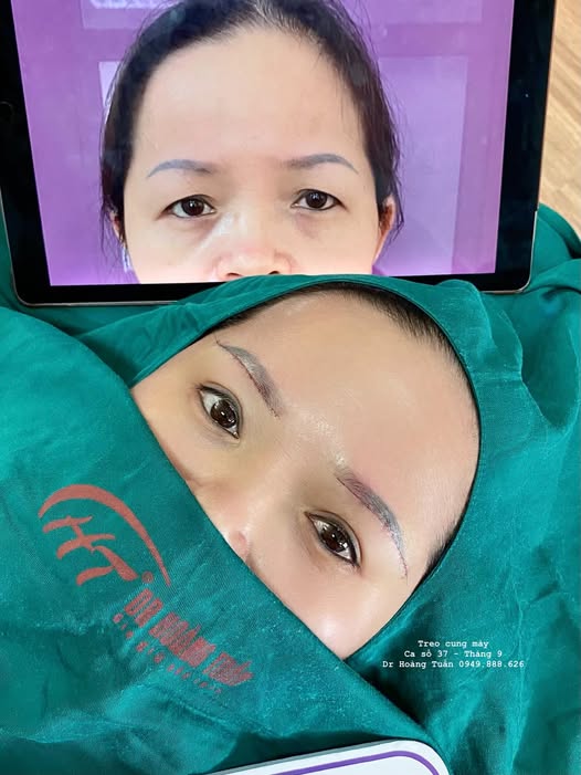 treo cung m&agrave;y bao l&acirc;u th&igrave; hồi phục