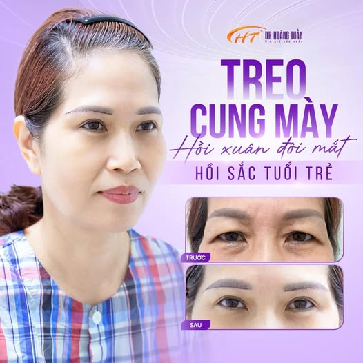 n&acirc;ng cung m&agrave;y bao l&acirc;u th&igrave; hết sẹo