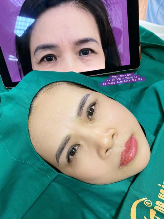 treo cung m&agrave;y mấy ng&agrave;y cắt chỉ