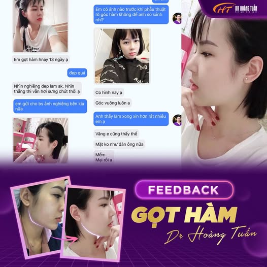 Gọt hàm có vĩnh viễn không