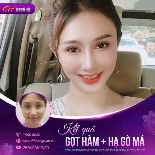 gọt h&agrave;m sưng bao l&acirc;u