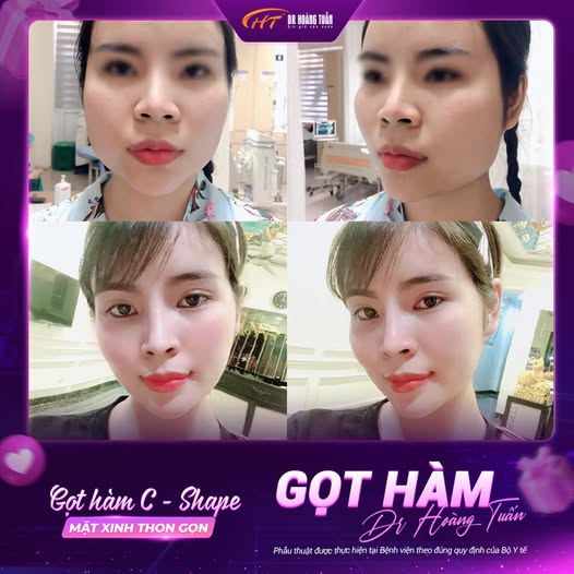 Gọt hàm có vĩnh viễn không