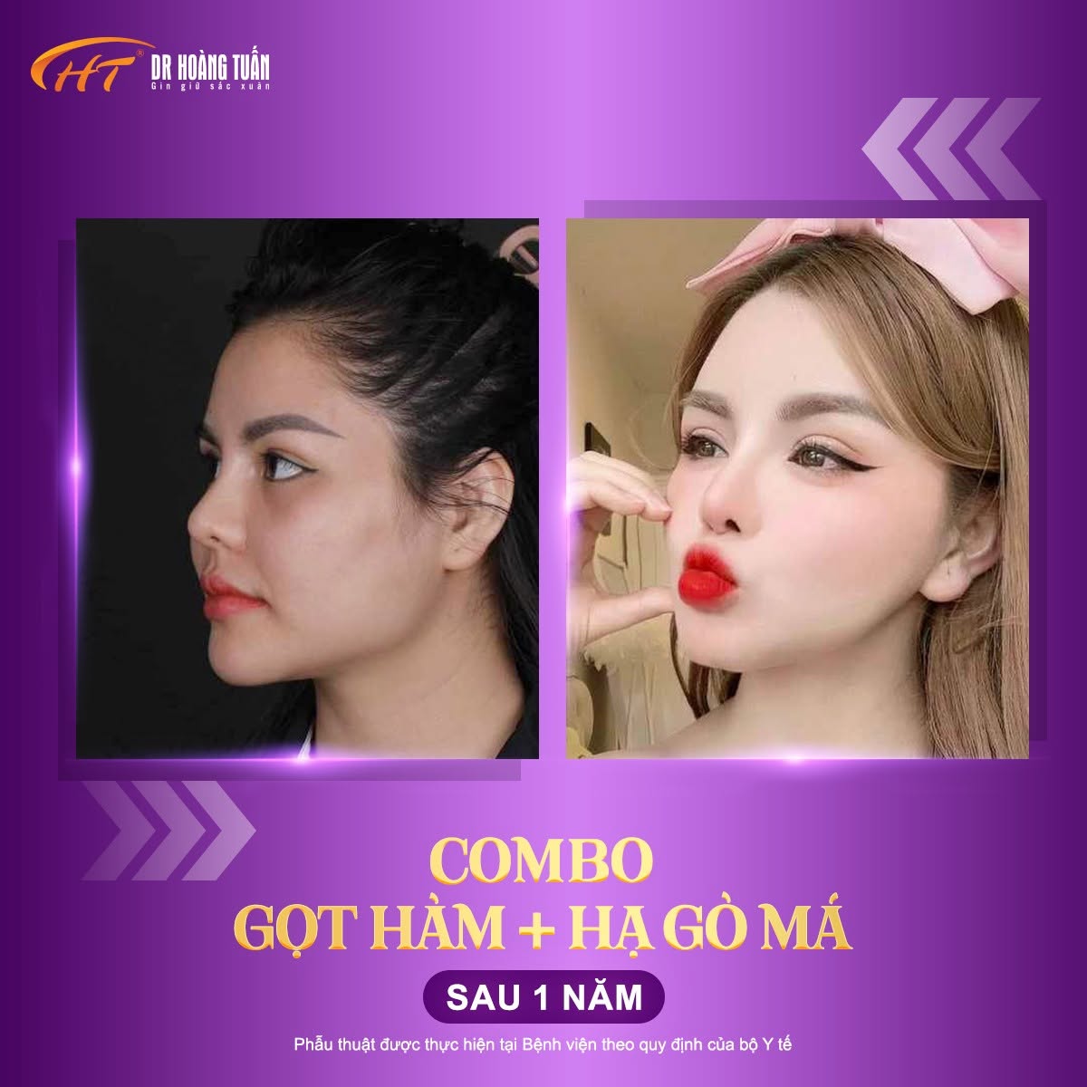 gọt h&agrave;m hạ g&ograve; m&aacute;