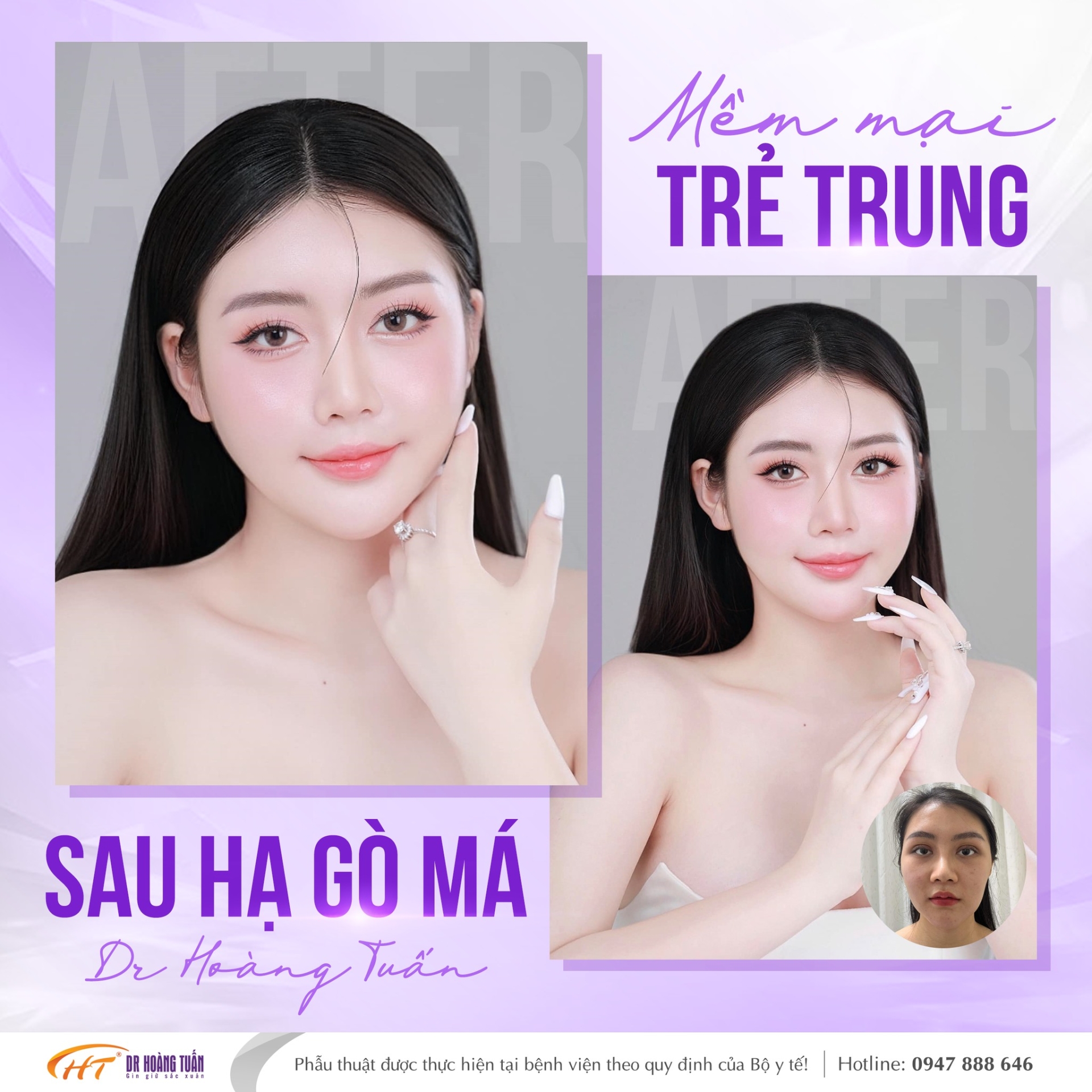 hạ g&ograve; m&aacute; l&agrave; g&igrave;