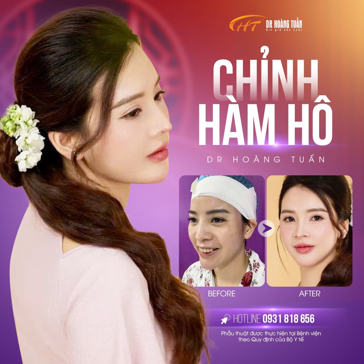 phẫu thuật h&agrave;m h&ocirc; bao l&acirc;u l&agrave;nh