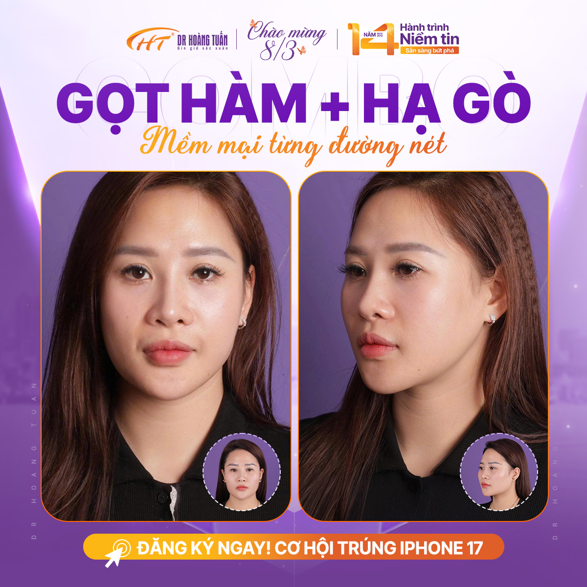 gọt h&agrave;m bao l&acirc;u hồi phục