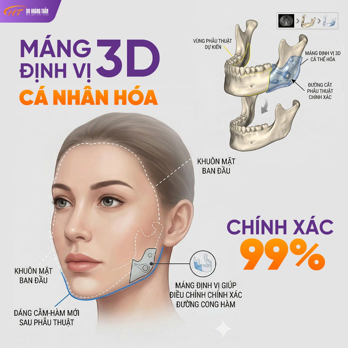 HT 3D Smart Cut