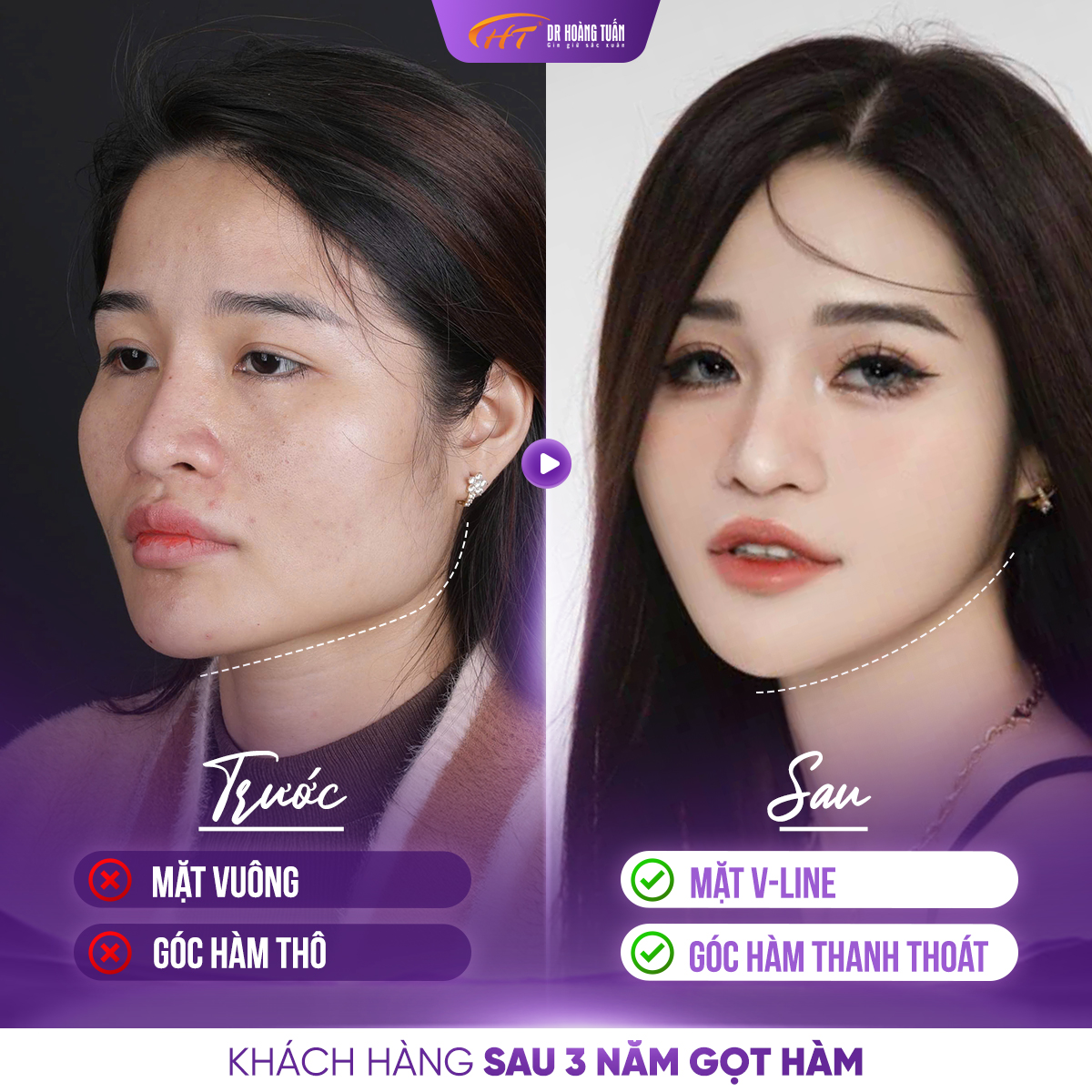 gọt h&agrave;m V line