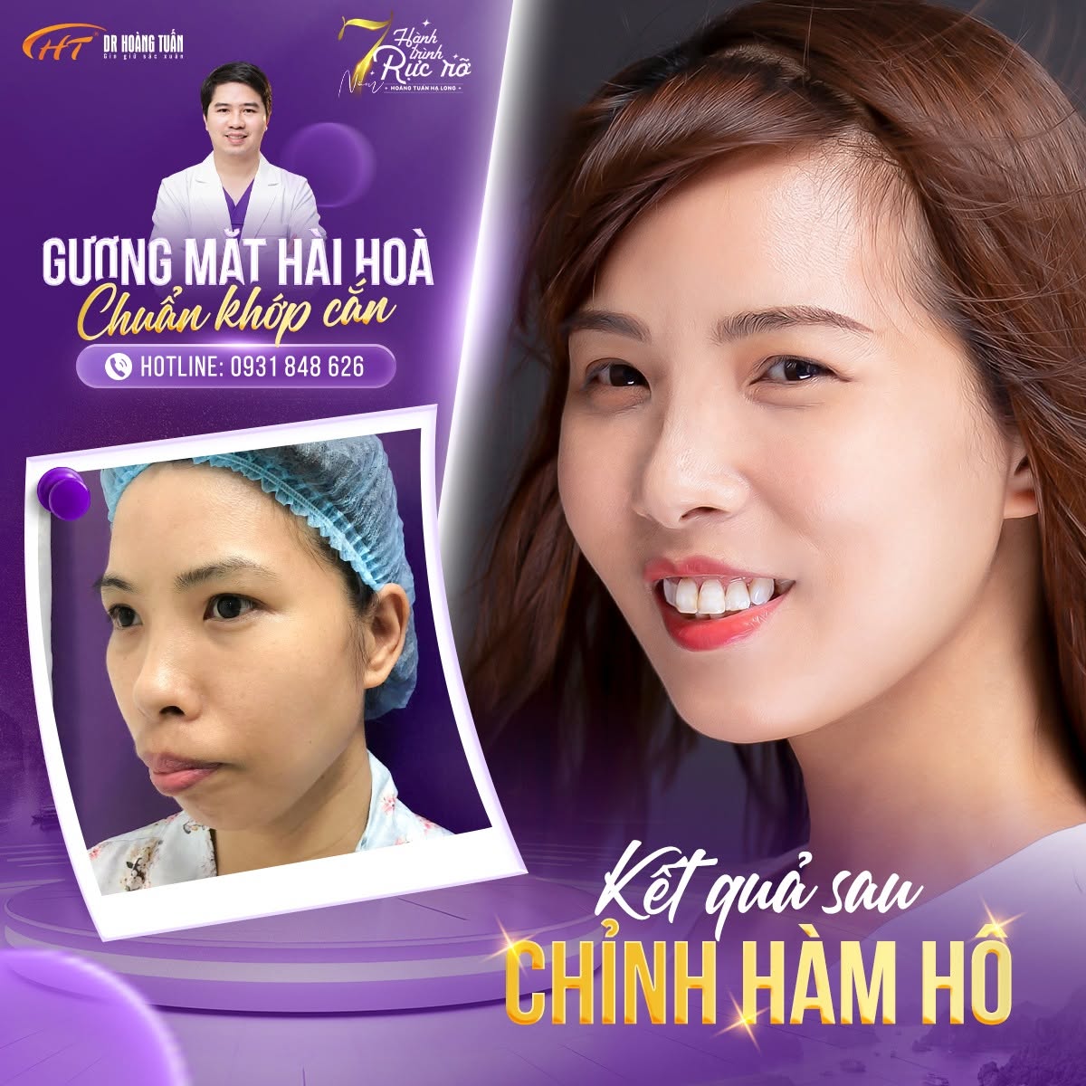 phẫu thuật chỉnh h&ocirc; ở đ&acirc;u uy t&iacute;n