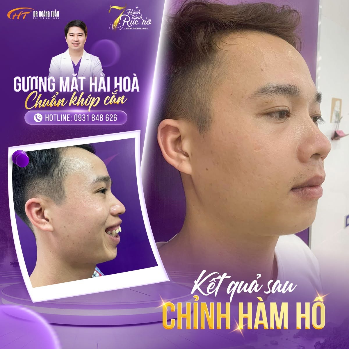 phẫu thuật h&agrave;m h&ocirc; bao l&acirc;u l&agrave;nh