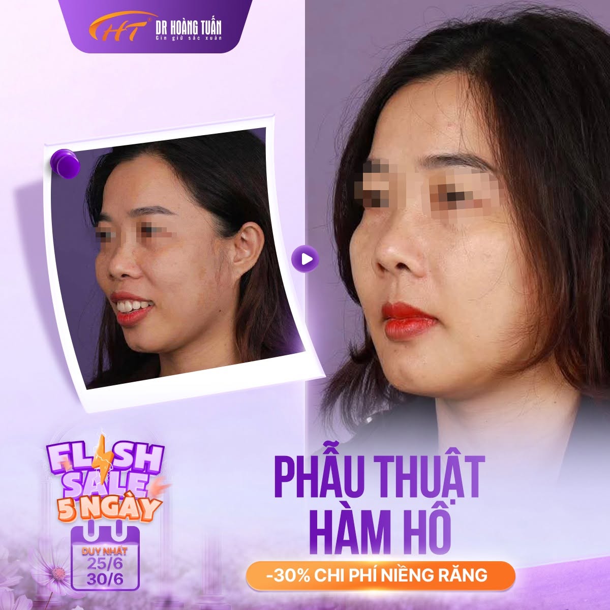 phẫu thuật chỉnh h&ocirc; ở đ&acirc;u uy t&iacute;n