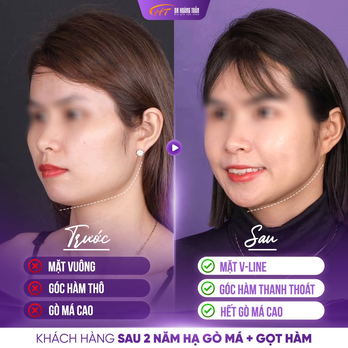 gọt h&agrave;m hạ g&ograve; m&aacute;