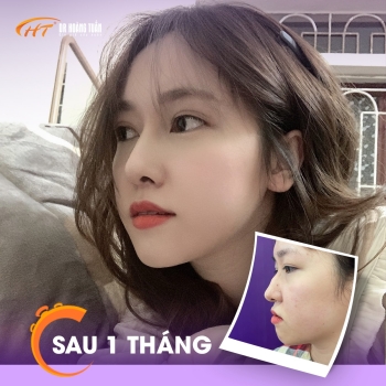 Phẫu thuật nâng mũi có đau không? Bao lâu hồi phục?