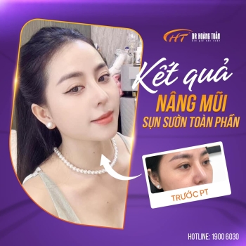 Chi phí nâng mũi sụn sườn giá bao nhiêu? Cập nhật bảng giá mới nhất tại Dr Hoàng Tuấn