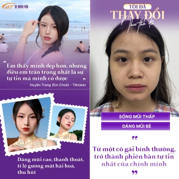 Huyền Trang bật chế độ rực rỡ tuổi đôi mươi - Hành trình nâng mũi Pureform để tự tin là chính mình