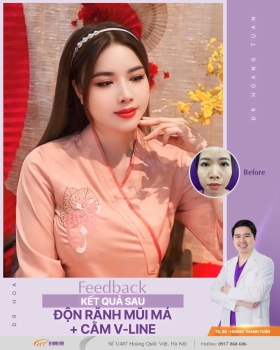 ĐỘN RÃNH MŨI MÁ