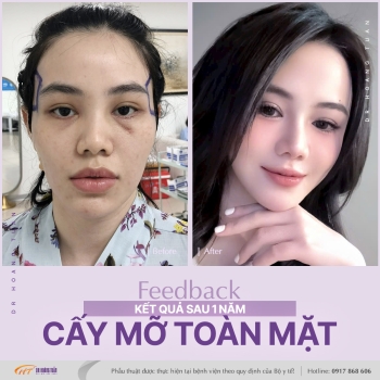 CẤY MỠ