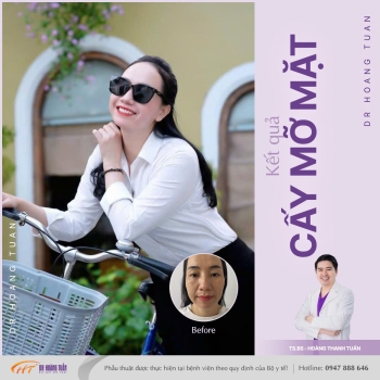 CẤY MỠ