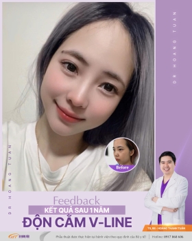 ĐỘN CẰM