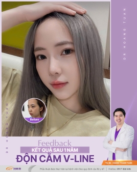 ĐỘN CẰM