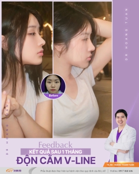ĐỘN CẰM