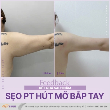 HÚT MỠ